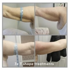 After-3-treatments-300x300